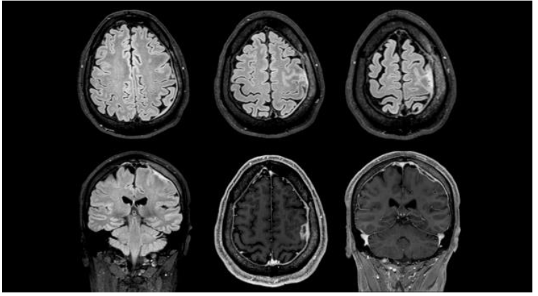 Cerebral MRI demonstrated focal frontoparietal pachymeningitis with gadolinium enhancement.