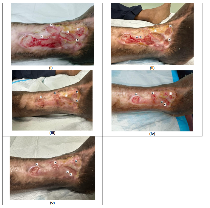 Serial photographic progression of the right lateral wounds following adjunctive MSC secretome therapy. (i) Baseline, Day 1 (TWSA 19.65cm2). (ii) Day 32. Showing transient increase in surface area due to wound coalescence (TWSA 33.32cm2). (iii) Day 70 (TWSA 12.0 cm2). (iv) Day 95 (TWSA 11.0cm2). (v) Day 126, demonstrating near-complete epithelialization with residual wound surface area of 2.4cm2. Note: Total wound surface area (TWSA) was calculated by summing the individual wound areas, each estimated using length x width.
