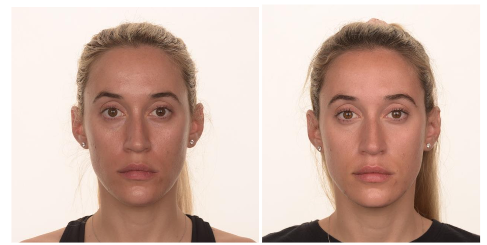 Figure 1. Before and after treatment for skin texture and rejuvenation. The patient undergone three sessions of microneedling treatment with a dermapen and on the face applied injectable-Platelet Rich Fibrin