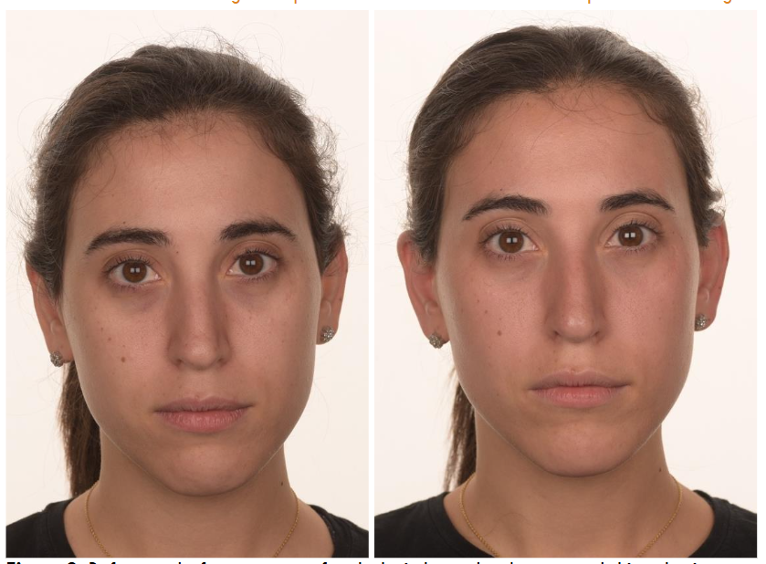 Figure 2. Before and after treatment for dark circles under the eye and skin color improvement.