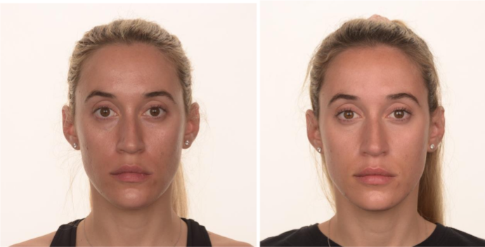 Figure 1. Before and after treatment for skin texture and rejuvenation. The patient undergone three sessions of microneedling treatment with a dermapen and on the face applied injectable-Platelet Rich Fibrin