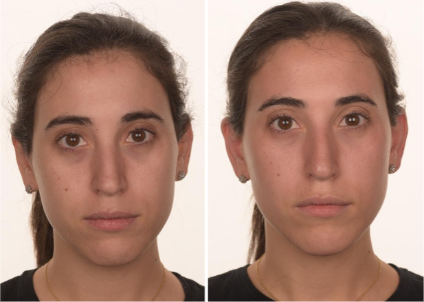 Figure 2. Before and after treatment for dark circles under the eye and skin color improvement.