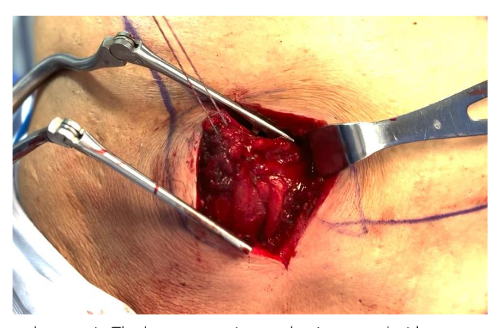 Lower trapezius tendon repair. The lower trapezius tendon is detached from the periosteum.