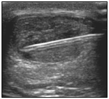 Figure 2: Ultrasound image of the short-axis, in-plane bone marrow concentrate injection into the Achilles Tendon using a medial-to-lateral approach.