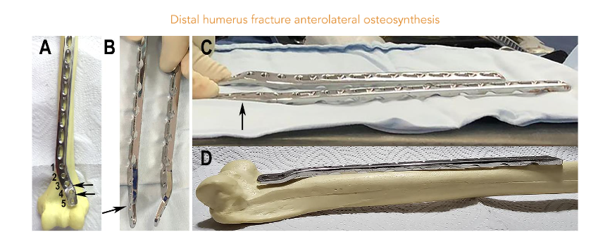 Figure 1. Molding of the plate. (A) The arrows indicate the levels where the molding takes place. (B and C) The molded plate indicated by the arrow is placed side by side to the original for comparison.