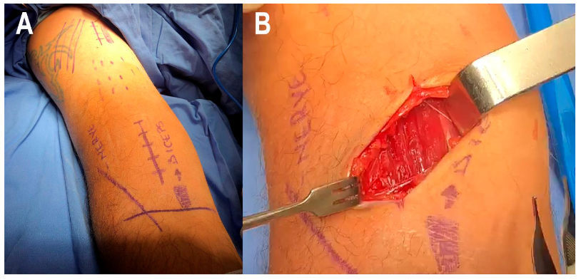 Figure 1. Humeral shaft exposure and second incision. The images display the exposure of the lateral column of the distal humerus (A) and the location of the second incision (B).