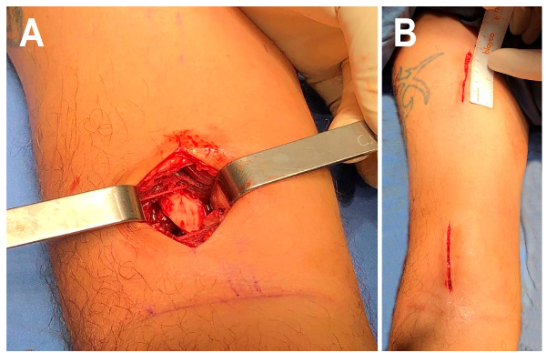 Figure 2. Plate sliding and positioning. The pictures depict the molded plate sliding in from distal to proximal over the humeral lateral surface (A) and the position of the distal end 1 cm proximal to the most proximal edge of the capitellum (B).
