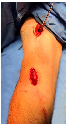 Figure 4. Plate fixation. The image shows the temporary proximal fixation.