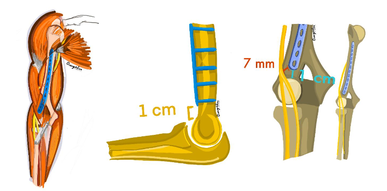 Figure 5. Anatomical relations. The illustrations depict the optimal position of the plate and the relationship of the plate with the capitellum and the radial nerve.