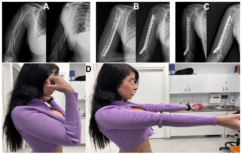 Figure 7. Case 1. A female 32 years old, with a right T-C3 fracture. 3 months' follow-up. C. Six and ten-month radiographic follow-up. D. AROM at ten months follow-up.