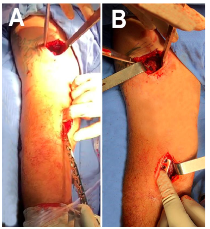 Figure 3. Plate fixation. A temporary proximal fixation is performed (Figure 4), followed by plate fixation with fixed blocks distally and the plate's position and fixation are confirmed with the image intensifier.