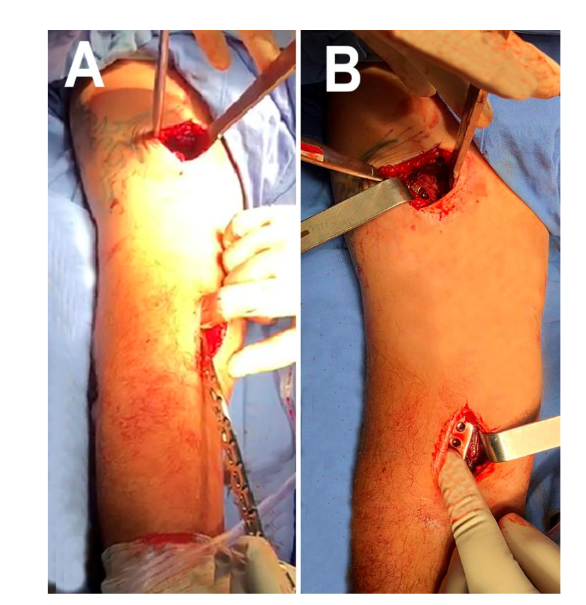 Figure 3. Plate sliding and positioning. The pictures depict the molded plate sliding in from distal to proximal over the humeral lateral surface (A) and the position of the distal end 1 cm proximal to the most proximal edge of the capitellum (B).