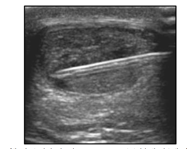 Figure 2: Ultrasound image of the short-axis, in-plane bone marrow concentrate injection into the Achilles Tendon using a medial-to-lateral approach.