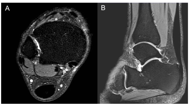 Figure 3: Fat suppressed T2-weighted magnetic resonance image of the distal leg revealing complete resolution of the hyperintense lesion in the midportion Achilles tendon shown in the pre-treatment MRI. (A) is the axial view and (B) is the sagittal view.