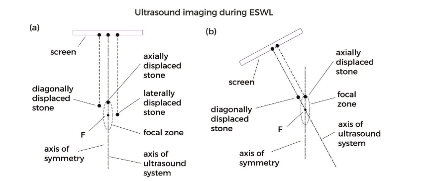 Diagram illustrating how diagonal and lateral displacements of urinary stones can be detected using in-line sonography. In contrast, axially displaced stones appear superimposed.