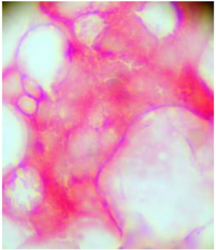 Figure 3: Bone marrow biopsy that is positive for CEA expressing cells (red) but MMP-2 negative. Or be positive for both the expression of CEA and MMP-2 (Figure 4).