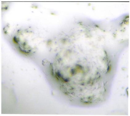 Figure 2: Bone marrow biopsy that is negative for CEA expressing cells. Bone marrow samples could be either positive for the presence of CEA expressing cells (Figure 3) and be negative for the expression of MMP-2.