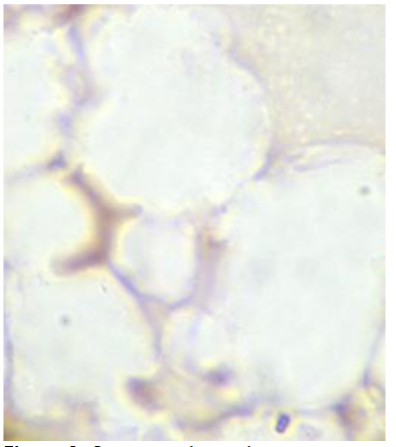 Figure 1: Bone sample touch preparation negative for CEA expressing tumour cells.