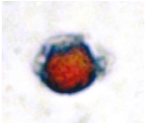 Figure 5: Circulating tumour cell, expressing CEA (red) and MMP-2 (brown).