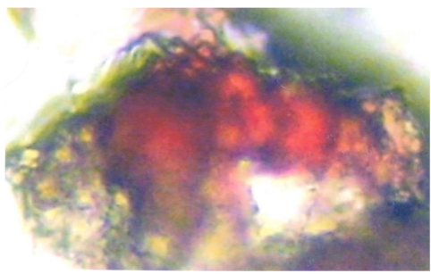 Figure 4: Bone marrow micro-metastasis CEA positive (red) and MMP-2 positive brown). Likewise circulating tumour cells detected in venous blood samples could be negative for the expression of CEA, in other words normal leukocytes, or express CEA and/or MMP-2 (Figure 5).