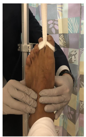Figure 3: Plantar to dorsal counterforce applied to the forefoot to exaggerate the subluxation, recreating the mechanism of injury.