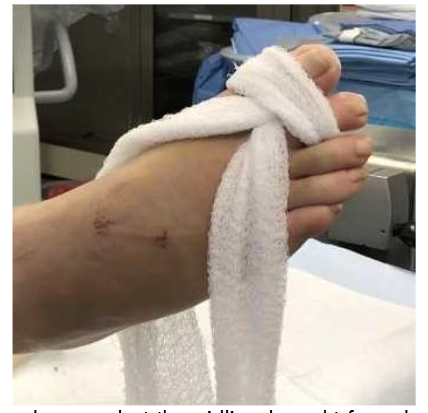 Figure 1: A gauze roll is unraveled and grasped at the midline, brought from dorsal to plantar between the first and second digits, and looped dorsally around the first and second toes.