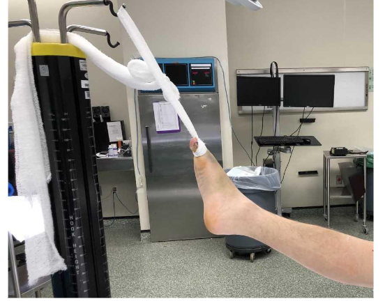 Figure 2: The free ends of the gauze roll are tightened and attached to an IV pole at the end of the hospital bed or operating table to suspend the leg.
