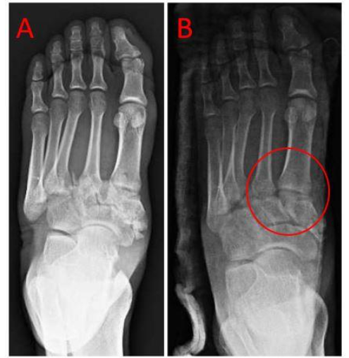 Figure 6: Midfoot dislocation with disruption of the Lisfranc complex (A) and Post-reduction (B) radiographs showing restoration of anatomical relationship of the Lisfranc complex.