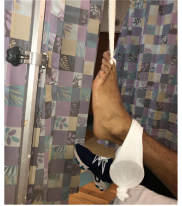 Figure 4: Additional counterforce is provided with weights placed around the ankle for injuries with difficult reduction.