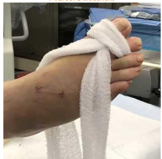 Figure 1: A gauze roll is unraveled and grasped at the midline, brought from dorsal to plantar between the first and second digits, and looped dorsally around the first and second toes.