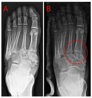 Figure 6: Midfoot dislocation with disruption of the Lisfranc complex (A) and Post-reduction (B) radiographs showing restoration of anatomical relationship of the Lisfranc complex.