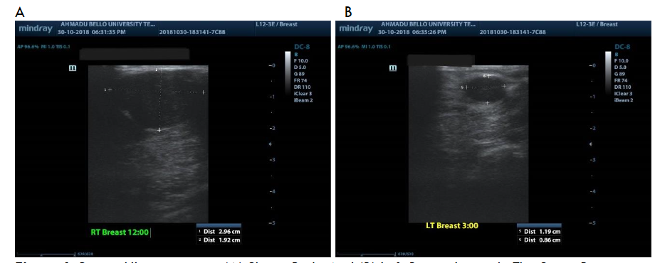 Bilateral Breast Lumps