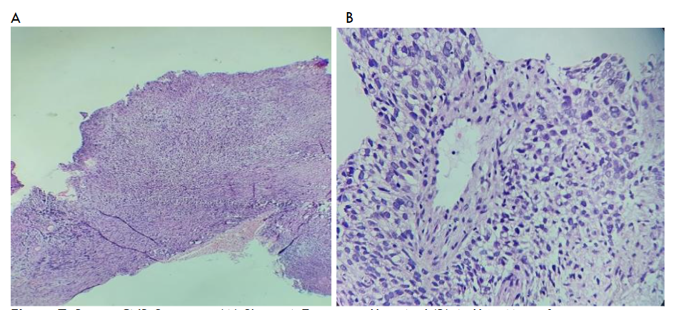 Breast CNB Specimen
