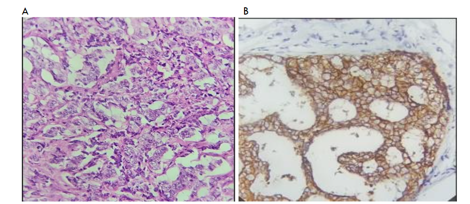 Breast Surgical Biopsy and Immunohistochemistry