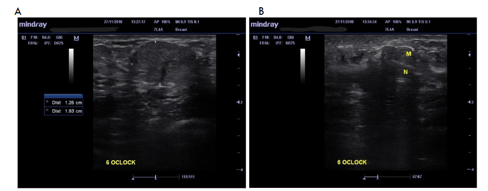Breast Mass and USS Guided Breast Biopsy