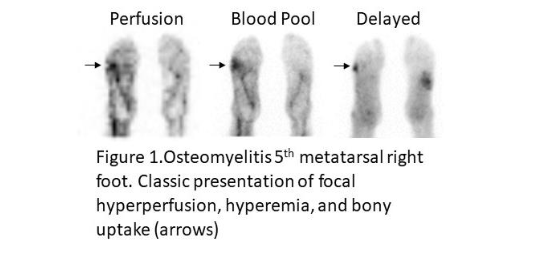Figure 1. Schematic representation of Ga<sup>67</sup> uptake in infection.