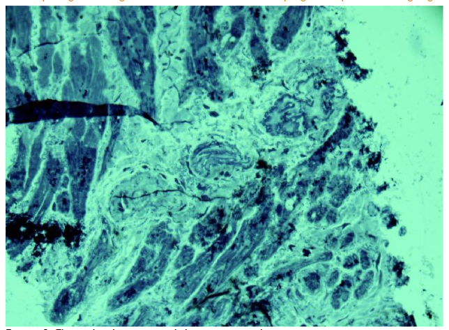 Figure 3. Three closely positioned de novo arterioles.