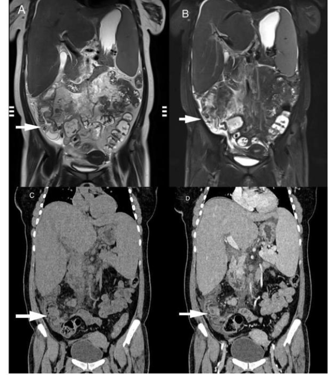 Figure 4: CT Coronal pre-contrast (L) and post contrast images show multiple discrete and confluent lymph nodes (arrow) showing homogeneous enhancement on post contrast image.