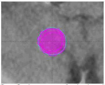 Volume variations after directly applying the “copy structure to registered image” function to different temporal point images.