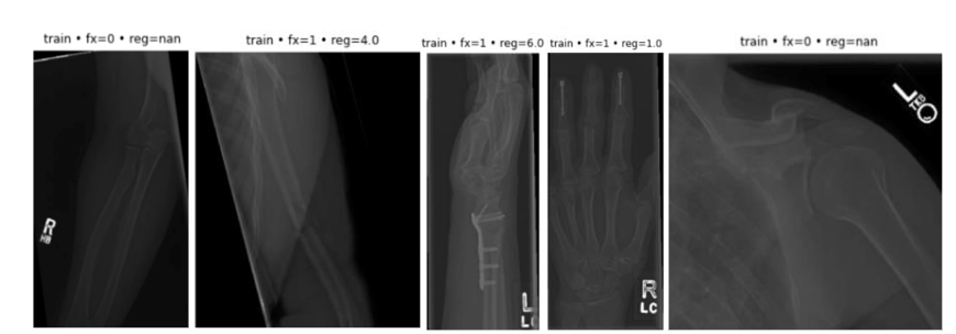Figure 2: Sample images of bone region and fracture