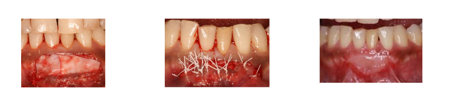 Fig C. Surgical photos showing a large connective tissue graft placed from # 23-26, which was sutured with 5.0 PTFE, a mono filament suture and three years post treatment photo showing a large zone of healthy and firm keratinized mucosa supporting 23-26.