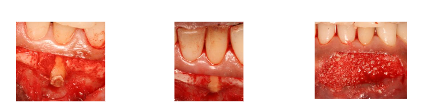 Fig B. Surgical photos showing visible hard deposits at the root apex, and an unhealed periapical region followed by apex reshaping and bone grafting.