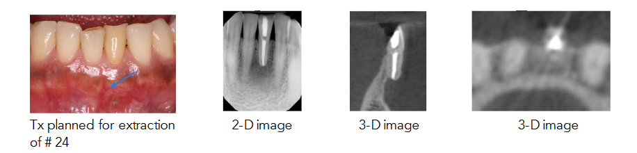 Fig A. Preoperative photo with arrowhead showing the mucosal fenestration, A 3 D imaging comparing with 2 D imaging shows missing the entire buccal plate along with presence of severe concavity at the apex of # 24.
