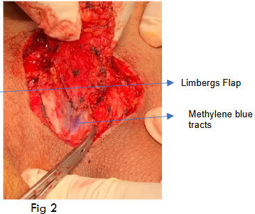 Methylene blue tracts