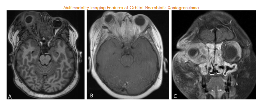 Figure 2: Axial precontrast T1 and axial and coronal post-contrast T1-weighted images show an infiltrative and enhancing right retro-orbital mass, resulting in significant right orbital proptosis and optic nerve stretching. Linear enhancement along the sclera, indicating scleritis, and widespread paranasal mucosal enhancement are also noted.