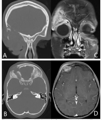 Figure 4: Langerhans cell histiocytosis; Coronal and axial orbital CT scans (A&B) show ill-defined lytic lesion in the right aspect of the frontal bone involving the orbital roof. Coronal and axial post contrast T1 Weighted fat saturated images (C&D) show enhancing and destructive centered on the right frontal bone superior orbital rim. The mass invades the right lacrimal gland with mild flattening of the superolateral right globe.