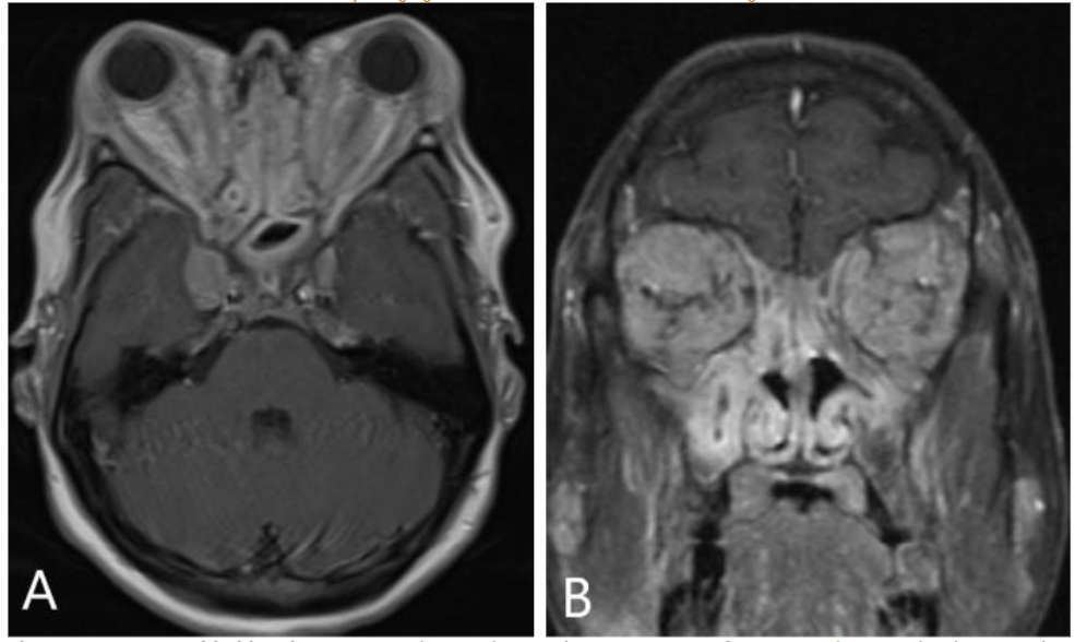 Figure 5: IgG4-RD orbital involvement; Axial (A) and coronal (B) post contrast fat saturated T1 weighted images show widespread infiltrative soft tissue throughout the bilaterally, encasing the extraocular muscles and optic nerves in this patient with. Note widespread mucosal thickening throughout the paranasal sinuses.