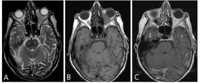 Figure 7: Orbital lymphoma; Axial T2 WI, pre contrast T1WI, and post contrast T1WI show T1/T2 hypointense enhancing intra/extraconal mass. Note clean appearance of the remaining left retro-orbital fat without stranding.