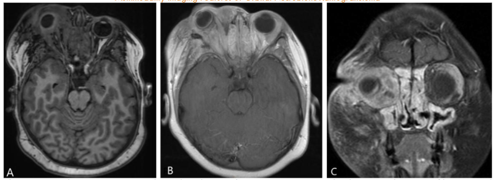 Figure 2: Axial precontrast T1 and axial and coronal post-contrast T1-weighted images show an infiltrative and enhancing right retro-orbital mass, resulting in significant right orbital proptosis and optic nerve stretching. Linear enhancement along the sclera, indicating scleritis, and widespread paranasal mucosal enhancement are also noted.