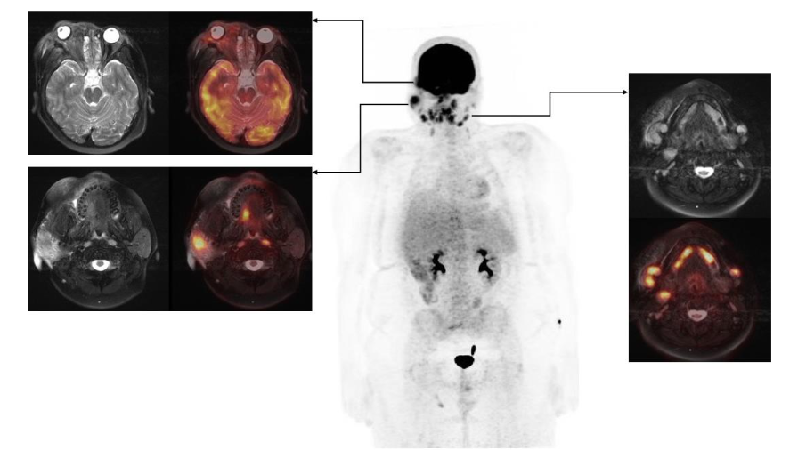 Figure 3: Standard protocol maximum intensity projection (MIP) and fused axial images at the level of the right orbit, right parotid gland, and upper cervical neck reveal an intensely hypermetabolic right retro-orbital mass, intense FDG uptake within the right parotid gland, and several intensely hypermetabolic cervical lymph nodes. There are no additional sites of FDG uptake throughout the body.